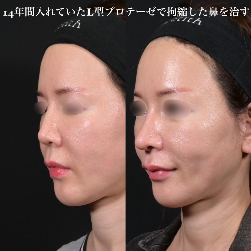 鉄医師による鼻のフルコースの施術前／施術後3ヶ月 Sau 