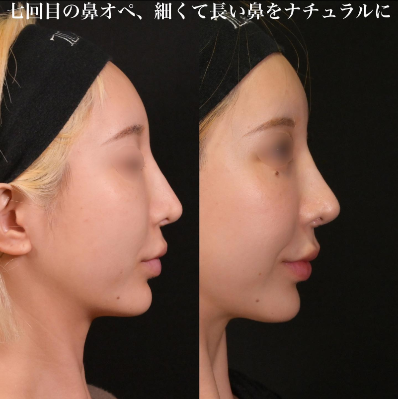 鉄医師による鼻のフルコースの施術前／施術後3ヶ月 施術後 
