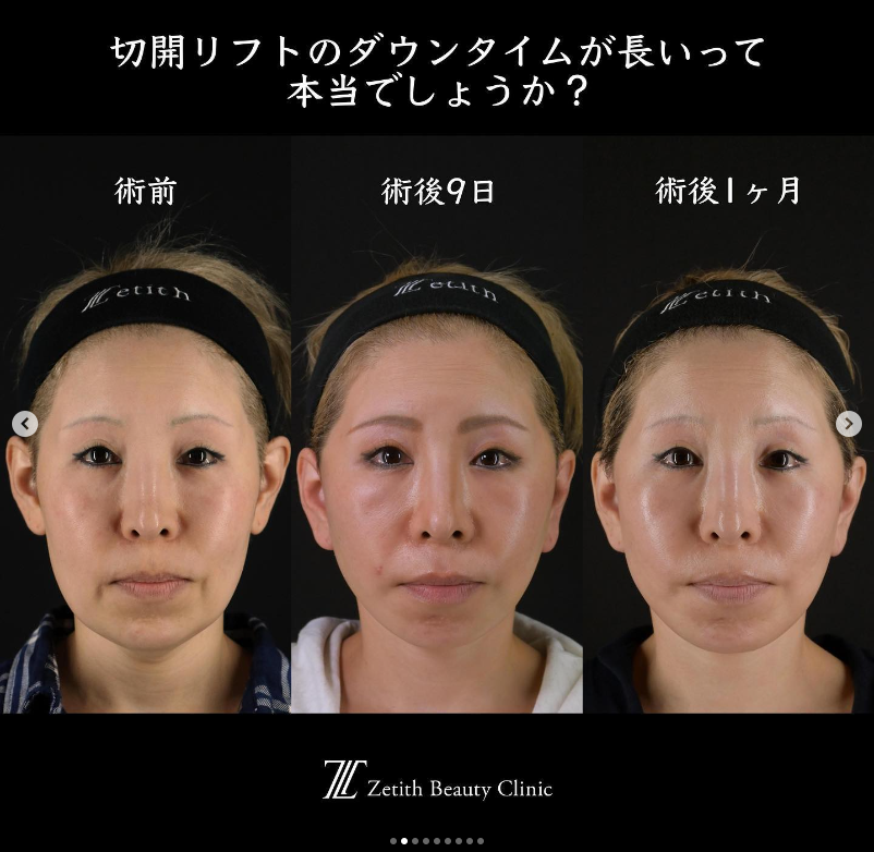 王医師による切開フェイスリフトの施術前／施術後1ヶ月 Sau 