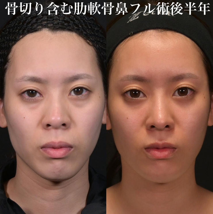 鉄医師による鼻のフルコースの施術前／施術後6ヶ月