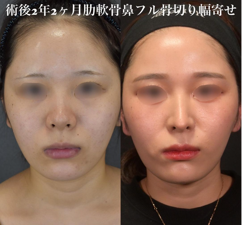 鉄医師による鼻のフルコースの施術前／施術後2年2ヶ月 施術後 