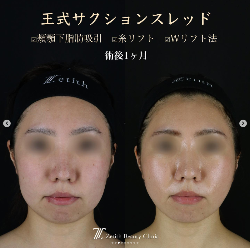 王医師による脂肪吸引＋糸リフトの施術前／施術後1ヶ月