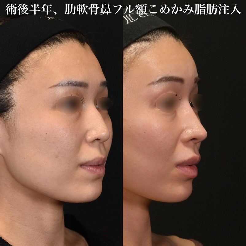 鉄医師による鼻のフルコースの施術前／施術後6ヶ月 After 