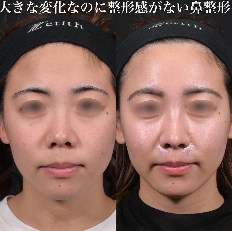 鉄医師による鼻のフルコースの施術前／施術後1ヶ月 术后 