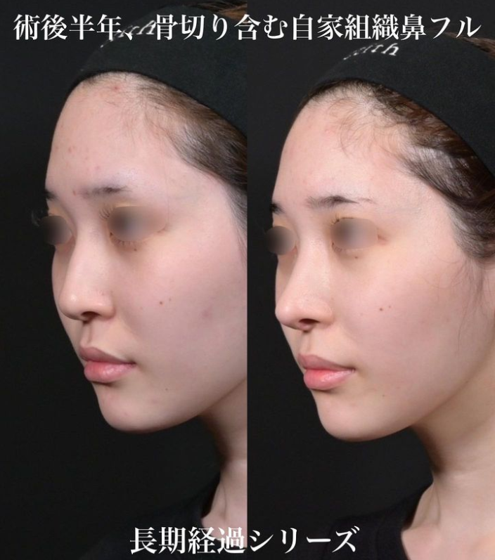 鉄医師による鼻のフルコースの施術前／施術後6ヶ月 术后 