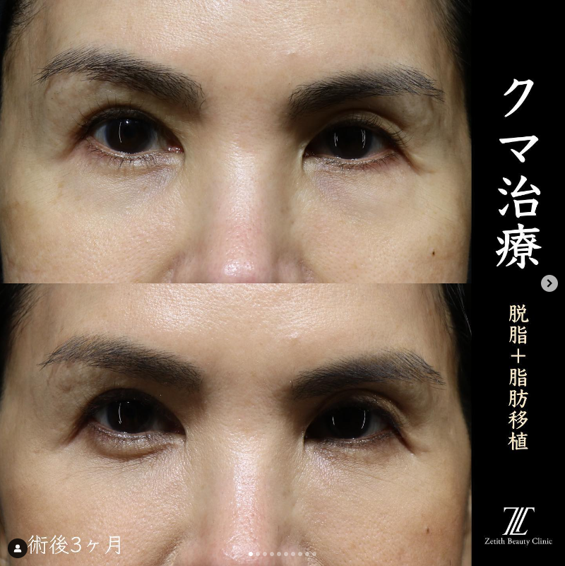 王医師によるクマ取り＋脂肪注入の施術前／施術3ヶ月 Дараа 