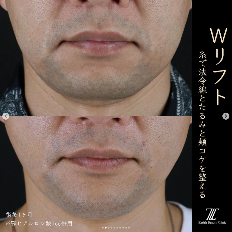王医師による糸リフトの施術前／施術1ヶ月 术后 