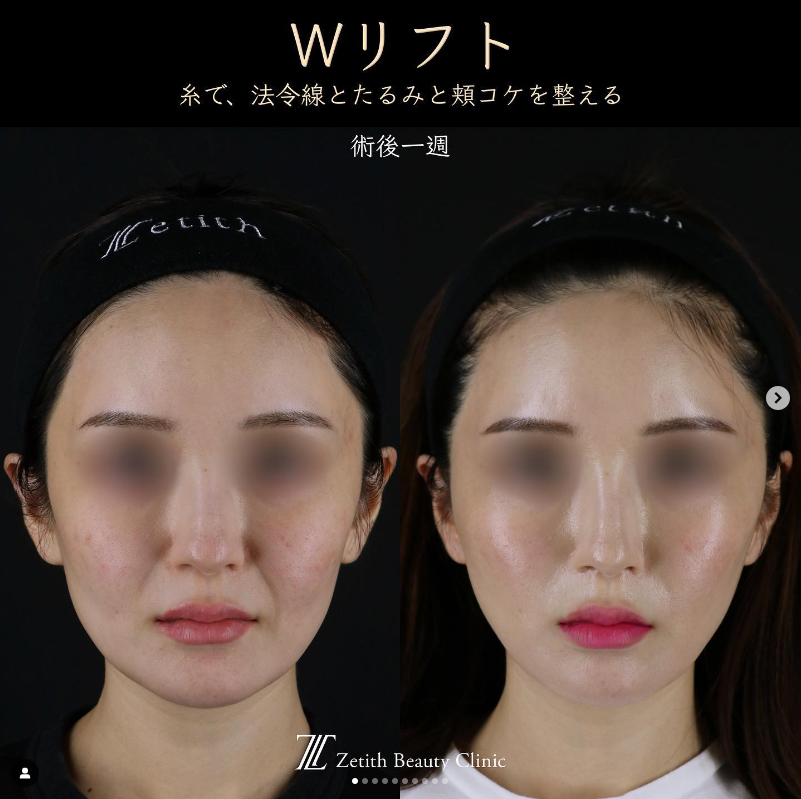 王医師による糸リフトの施術前／施術後1週間 施術後 