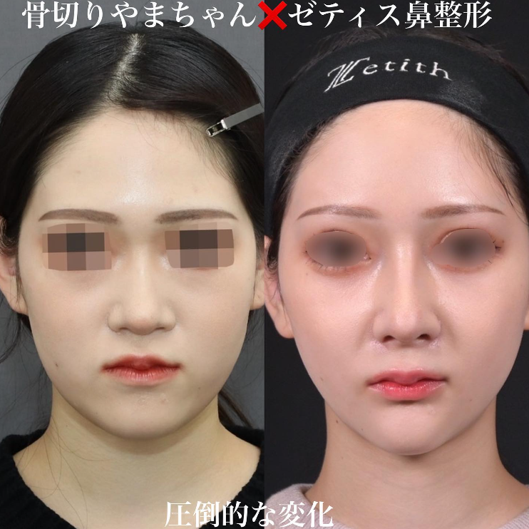 鉄医師による鼻のフルコースの施術前／施術後1ヶ月