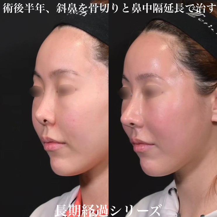 鉄医師による鼻のフルコースの施術前／施術後6ヶ月 Дараа 