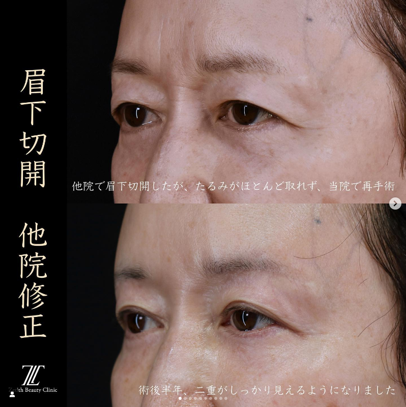 《術後6ヶ月》王医師による眉下切開の施術前／施術後6ヶ月 术后 