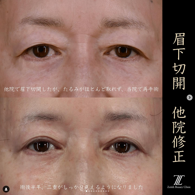 《術後6ヶ月》王医師による眉下切開の施術前／施術後6ヶ月