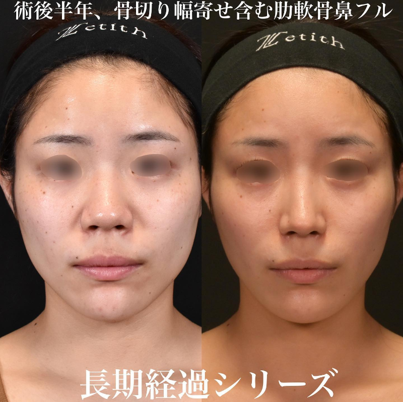 鉄医師による鼻のフルコースの施術前／施術後6ヶ月