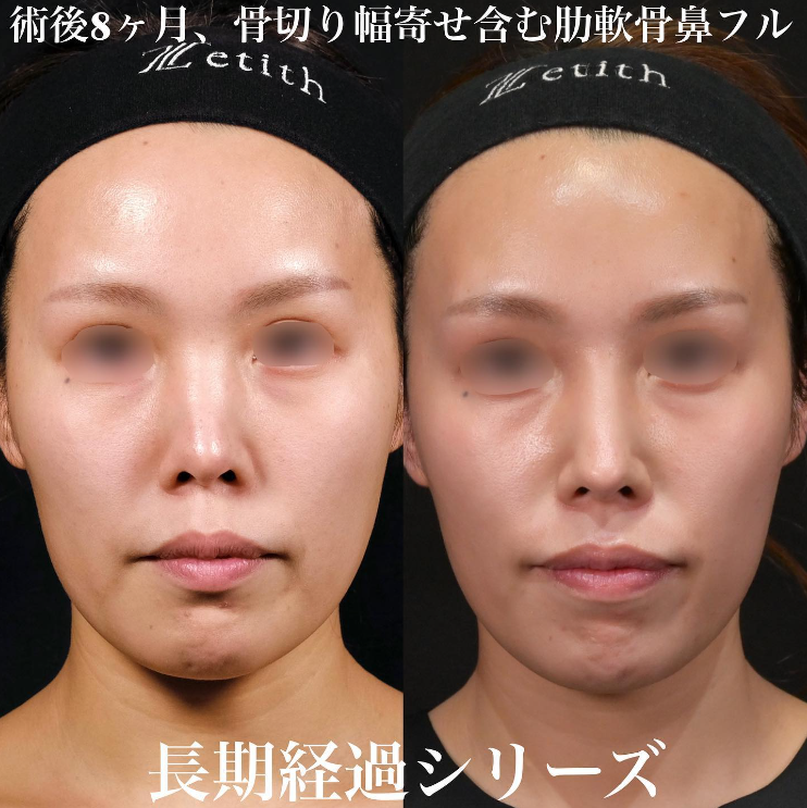 鉄医師による鼻のフルコースの施術前／施術後8ヶ月 หลัง 