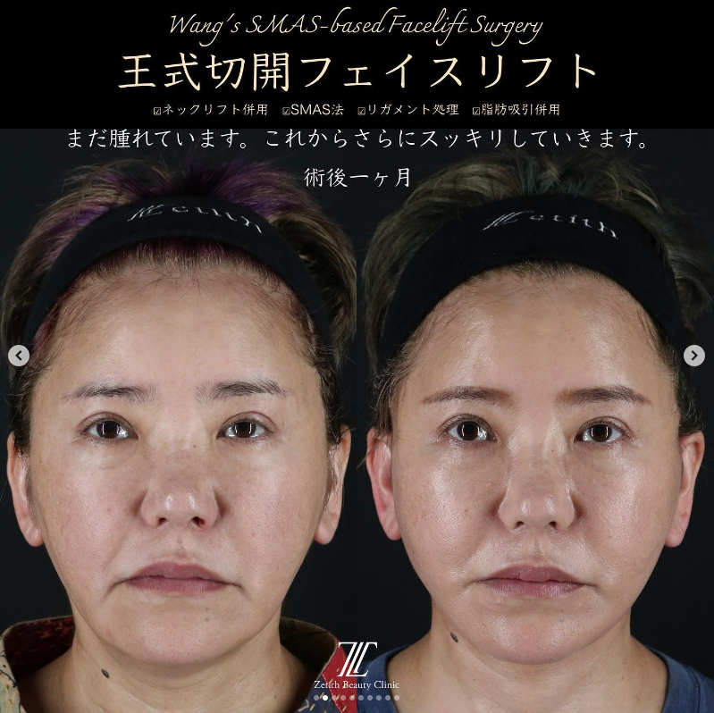 王医師による切開フェイスリフトの施術前／施術後1ヶ月