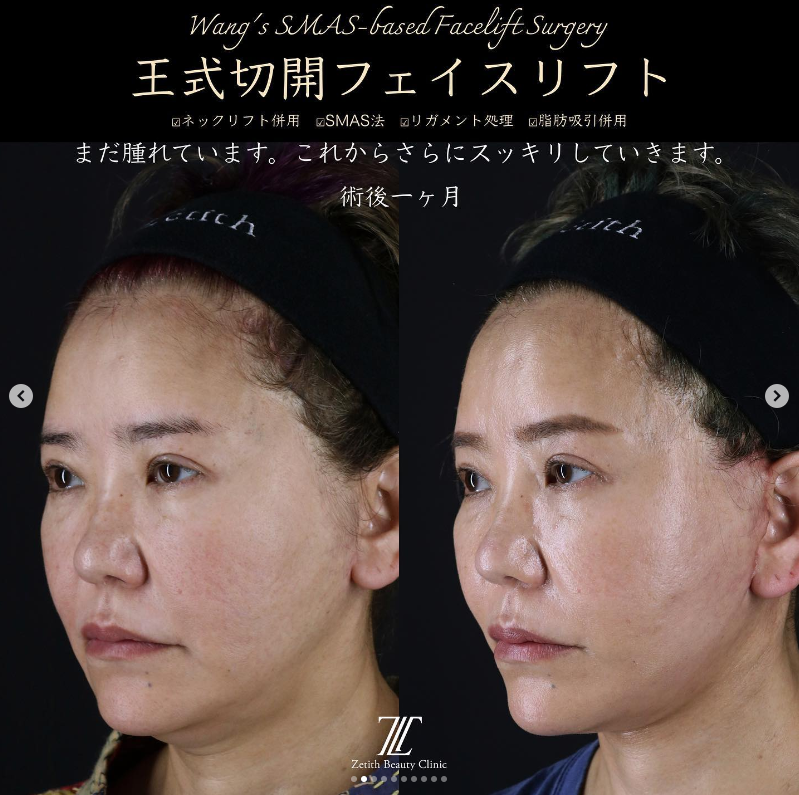 王医師による切開フェイスリフトの施術前／施術後1ヶ月 Дараа 