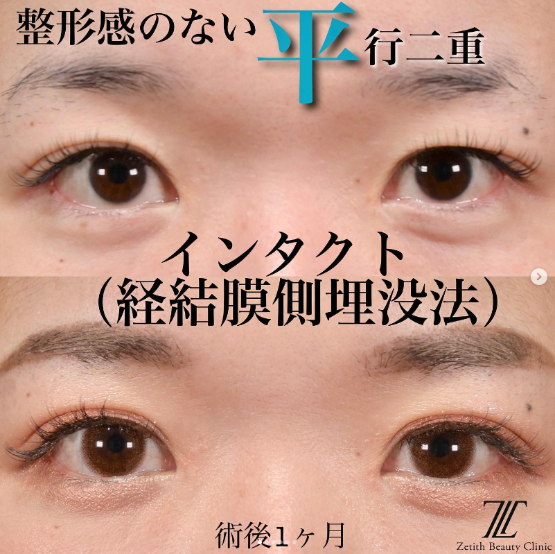 上木原医師による二重埋没法（Zetithインタクト）の施術前／施術後1ヶ月
