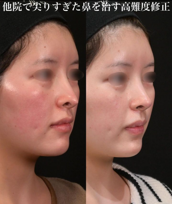 鉄医師による鼻のフルコースの施術前／施術後1ヶ月 术后 