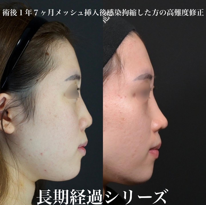 鉄医師による鼻のフルコースの施術前／施術後1年7ヶ月