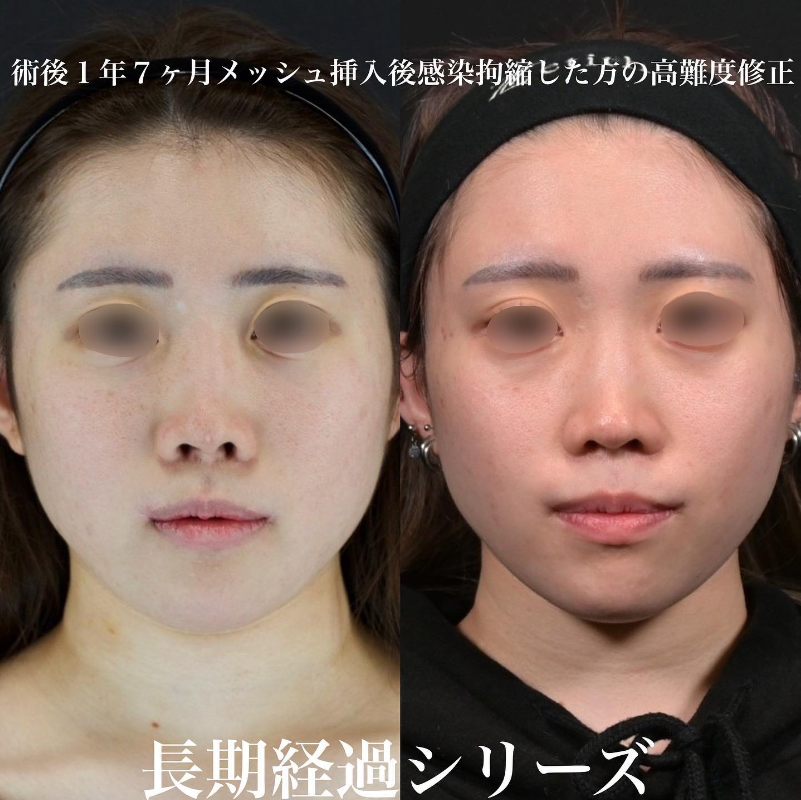 鉄医師による鼻のフルコースの施術前／施術後1年7ヶ月 施術後 