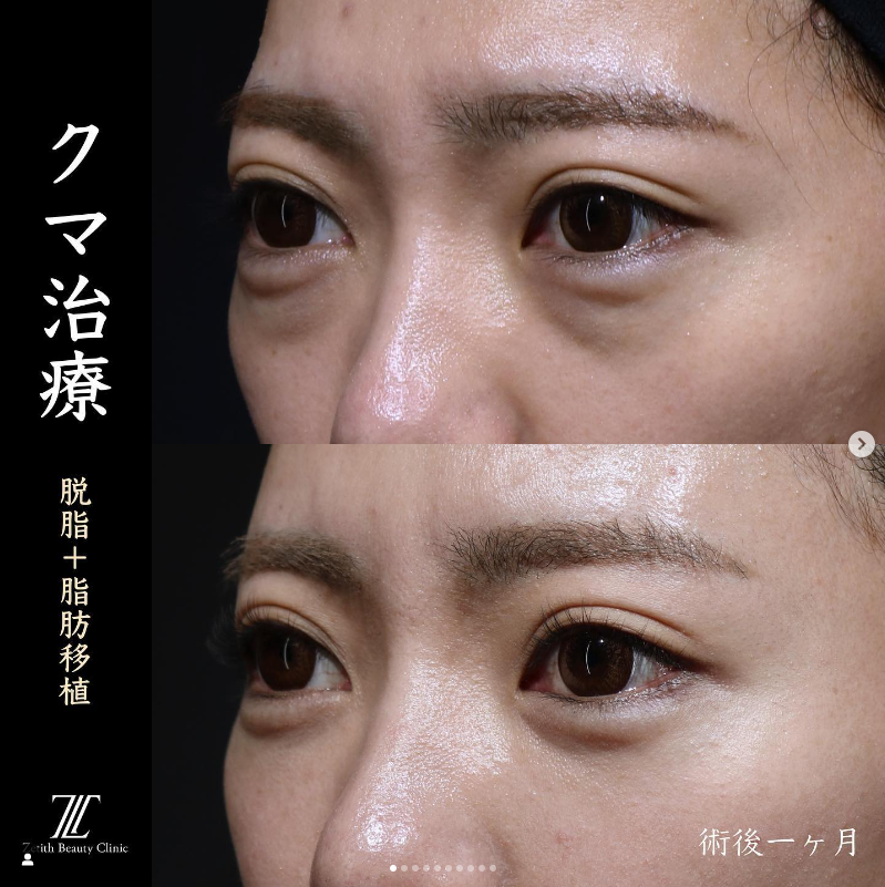 王医師によるクマ取り＋脂肪注入の施術前／施術後1ヶ月 After 