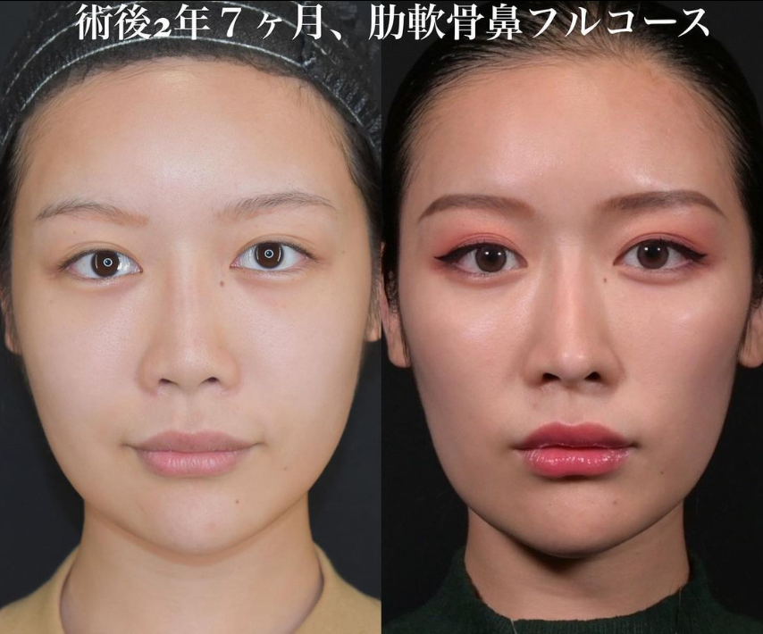 鉄医師による鼻のフルコースの施術前／施術後2年7ヶ月 术后 