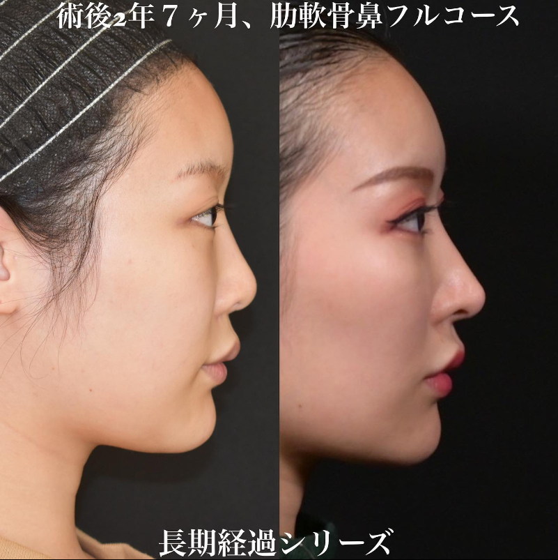 鉄医師による鼻のフルコースの施術前／施術後2年7ヶ月