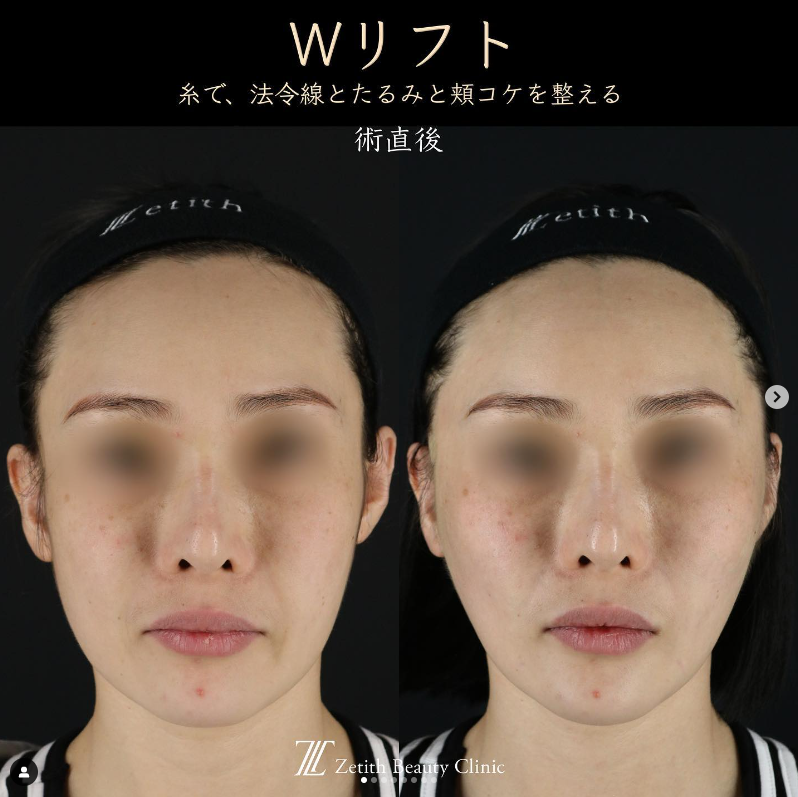 王医師による糸リフトの施術前／施術直後