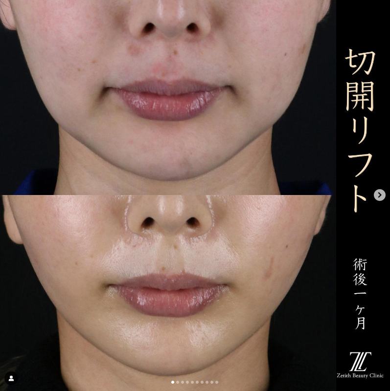 王医師による切開フェイスリフト＋ネックリフトの施術前／施術後1ヶ月