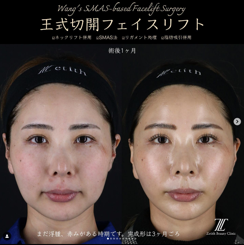 王医師による切開フェイスリフト＋ネックリフトの施術前／施術後1ヶ月 施術後 