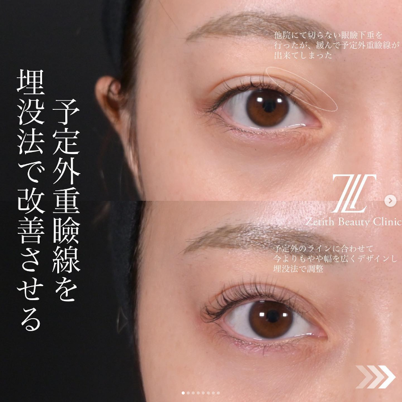北村医師によるZetithクロスの施術前／施術後1ヶ月