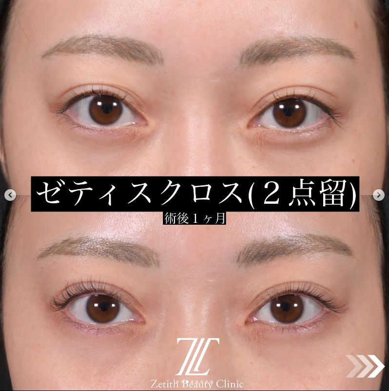 北村医師によるZetithクロスの施術前／施術後1ヶ月 After 