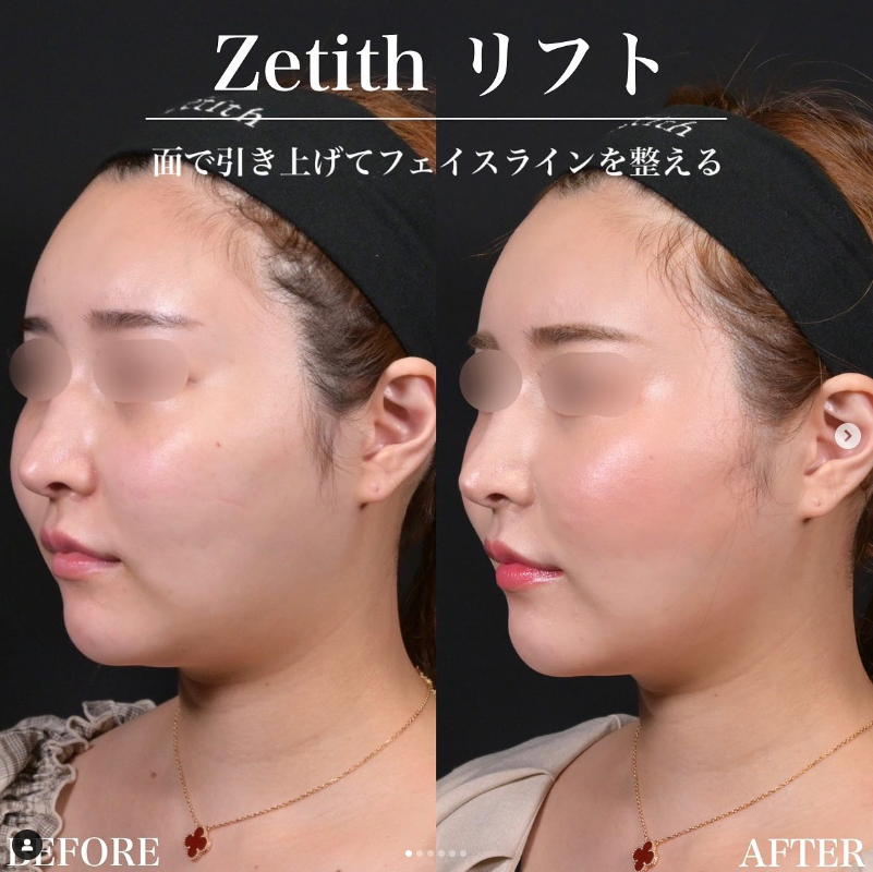 新井医師による糸リフトの施術前／施術後1週間