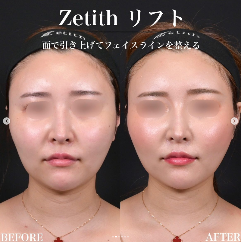 新井医師による糸リフトの施術前／施術後1週間 Sau 