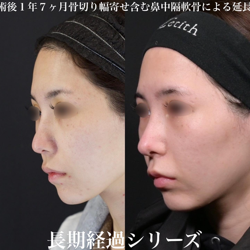 鉄医師による鼻のフルコースの施術前／施術後1年7ヶ月