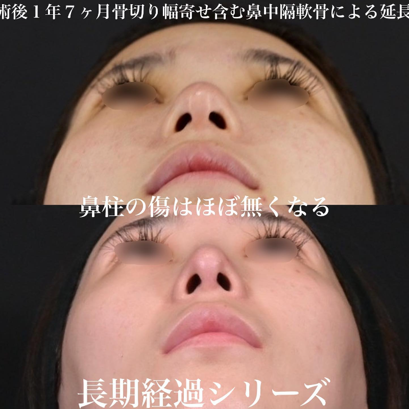 鉄医師による鼻のフルコースの施術前／施術後1年7ヶ月 Дараа 