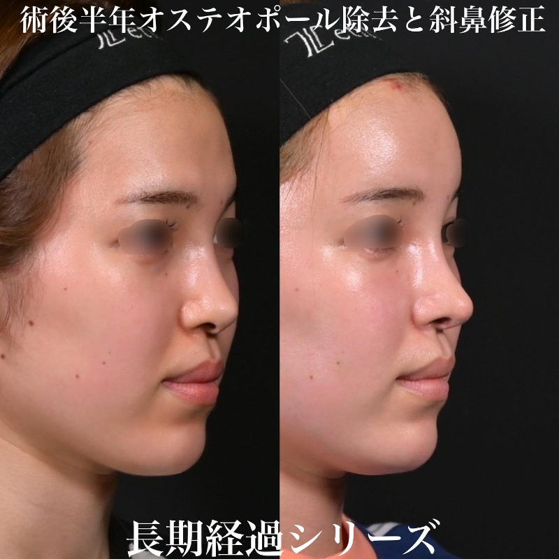 鉄医師による鼻のフルコースの施術前／施術後6ヶ月