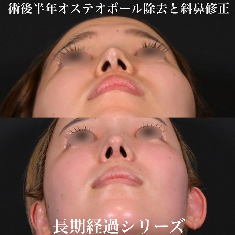 鉄医師による鼻のフルコースの施術前／施術後6ヶ月 Sau 術後6ヵ月