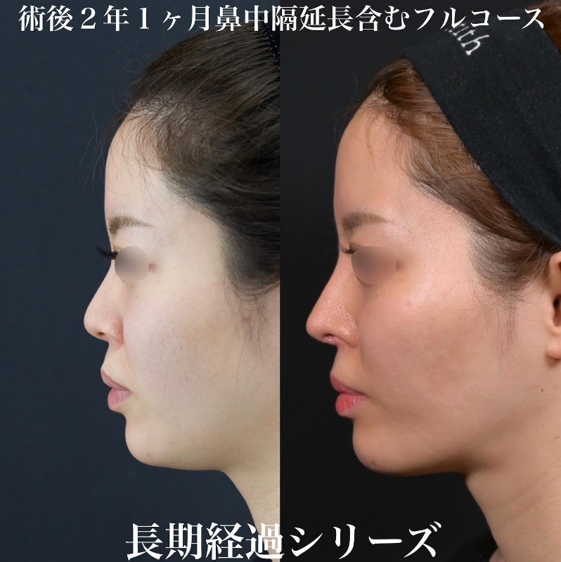 鉄医師による鼻のフルコースの施術前／施術後2年1ヶ月