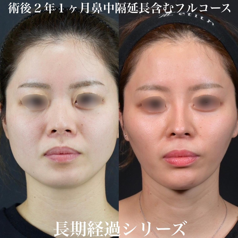 鉄医師による鼻のフルコースの施術前／施術後2年1ヶ月 施術後 