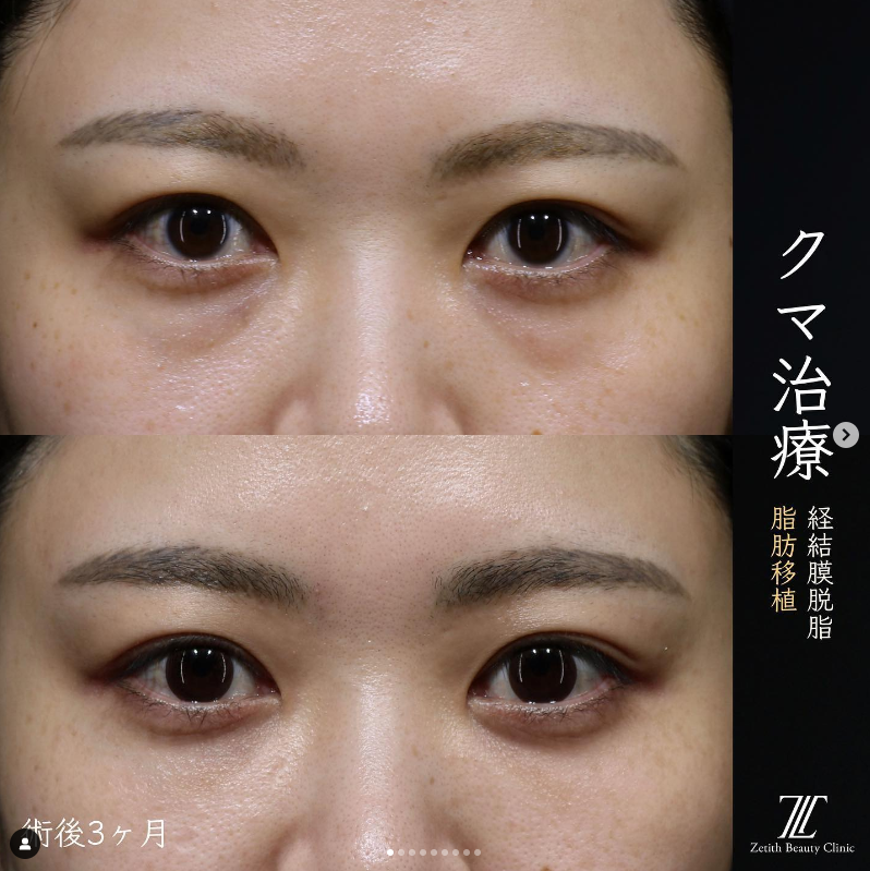 王医師によるクマ取りの施術前／施術後3ヶ月