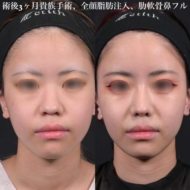 鉄医師による鼻のフルコースの施術前／施術後3ヶ月