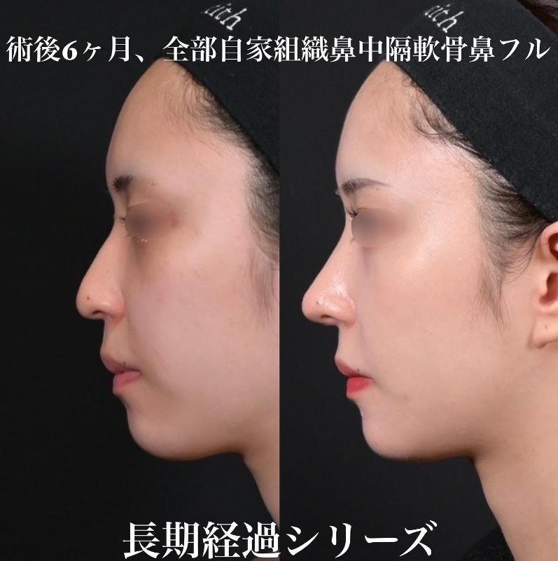 鉄医師による鼻のフルコースの施術前／施術後6ヶ月