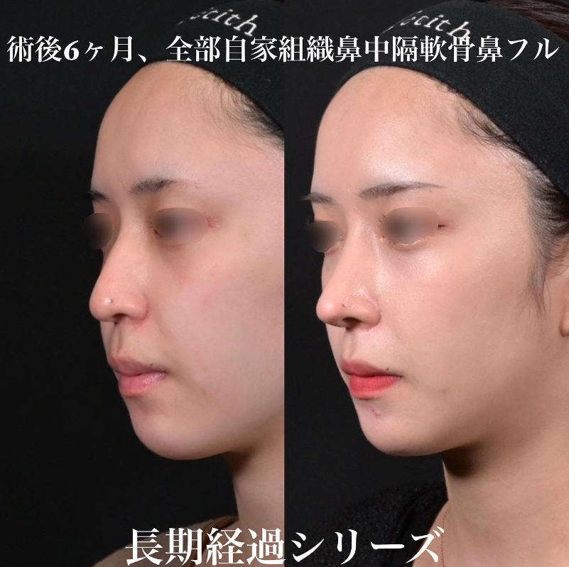 鉄医師による鼻のフルコースの施術前／施術後6ヶ月 施術後 