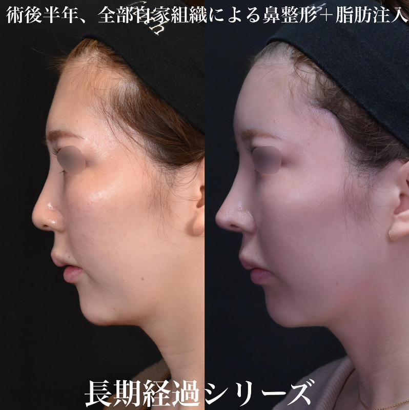 鉄医師による鼻のフルコースの施術前／施術後6ヶ月