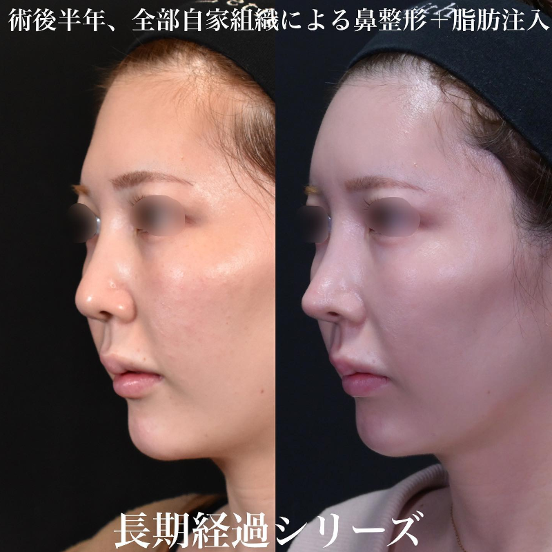鉄医師による鼻のフルコースの施術前／施術後6ヶ月 Дараа 