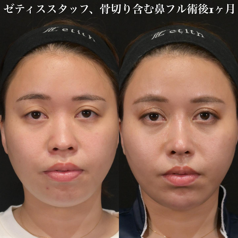 鉄医師による鼻のフルコースの施術前／施術後1ヶ月