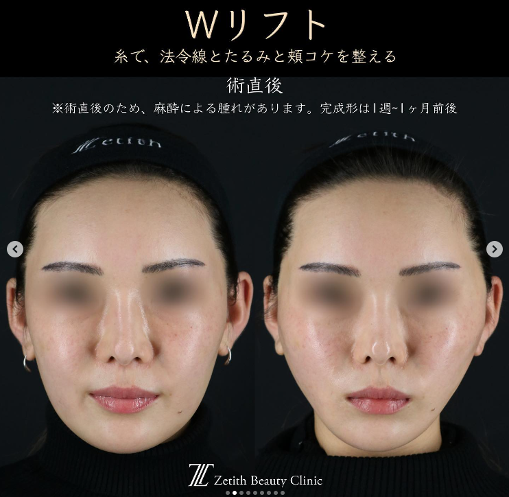 王医師による糸リフトの施術前／施術直後 施術後 