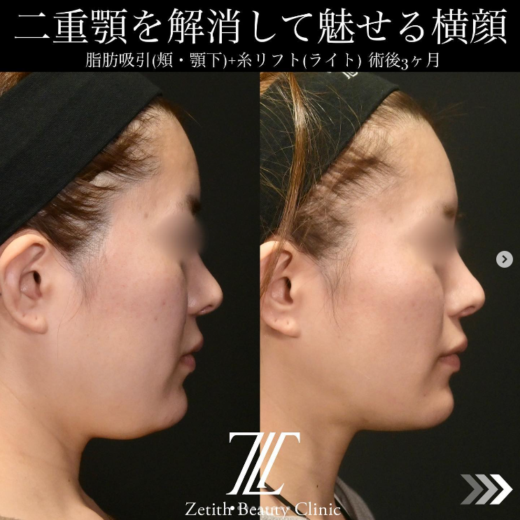 北村医師による脂肪吸引＋糸リフトの施術前／施術後3ヶ月