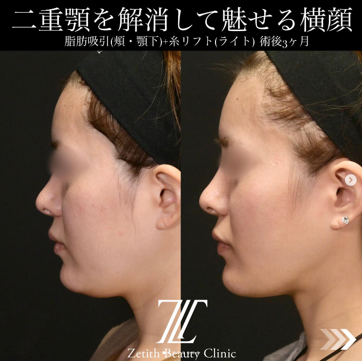 北村医師による脂肪吸引＋糸リフトの施術前／施術後3ヶ月 施術後 